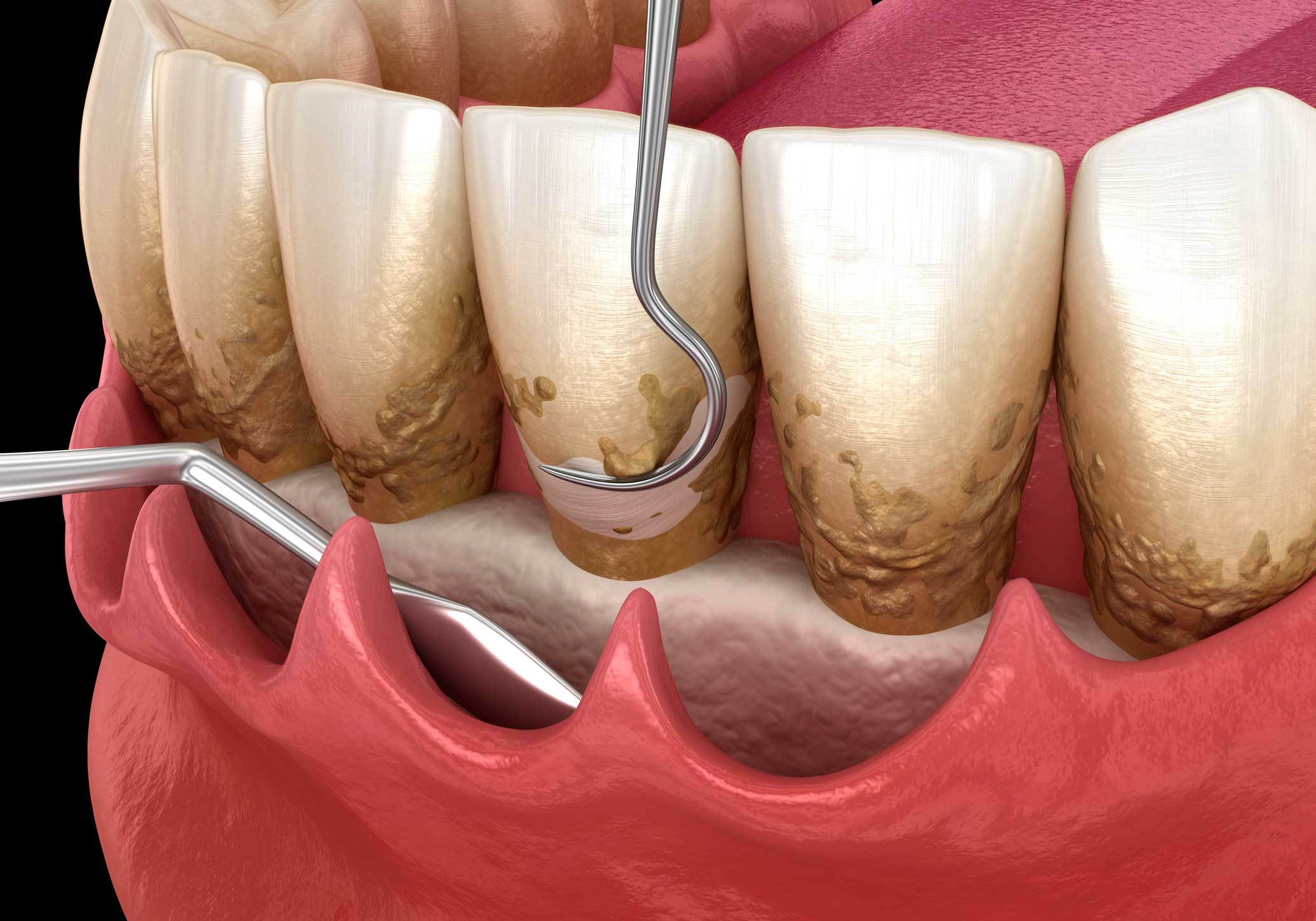 Periodoncia en Retiro, tratamientos de periodoncia en Retiro, Madrid; tratamiento para las encías en Retiro, curar las encías.