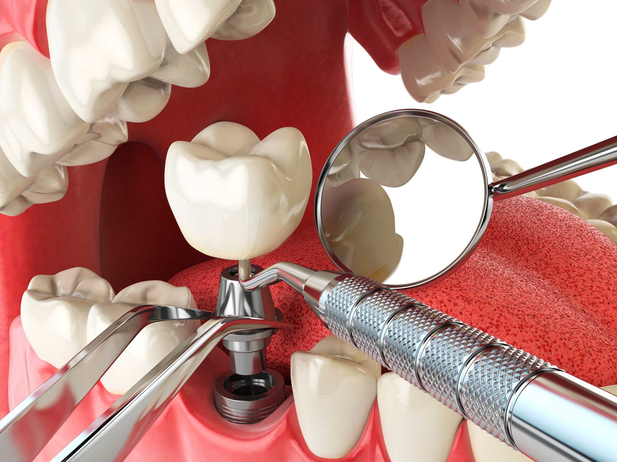 Implantes dentales en Retiro, implantes en Retiro, Implantología Oral en Retiro.