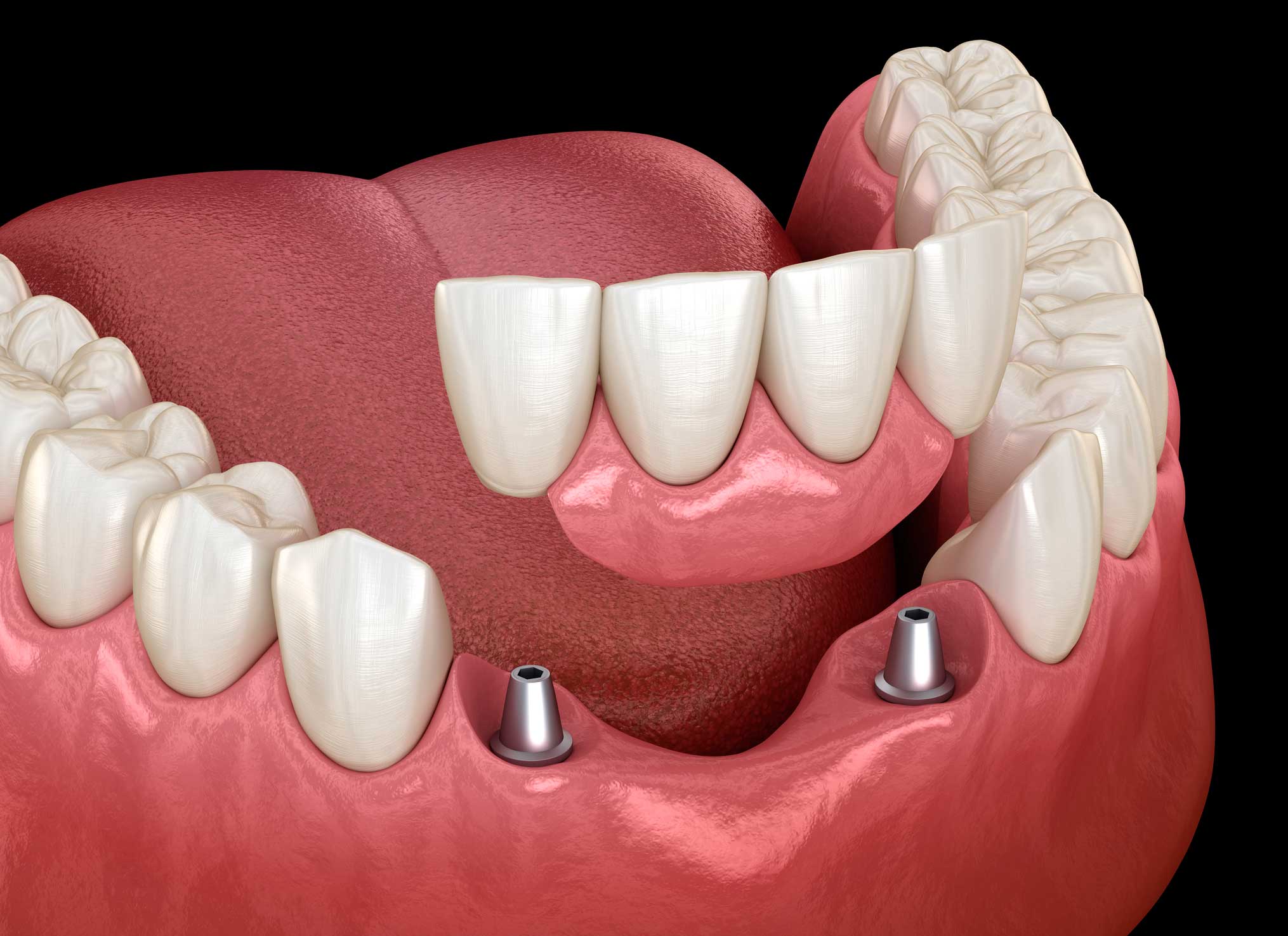 Prótesis dentales en Retiro, Prostodoncia en Retiro, prótesis en Retiro, Madrid; prótesis dentales fijas.