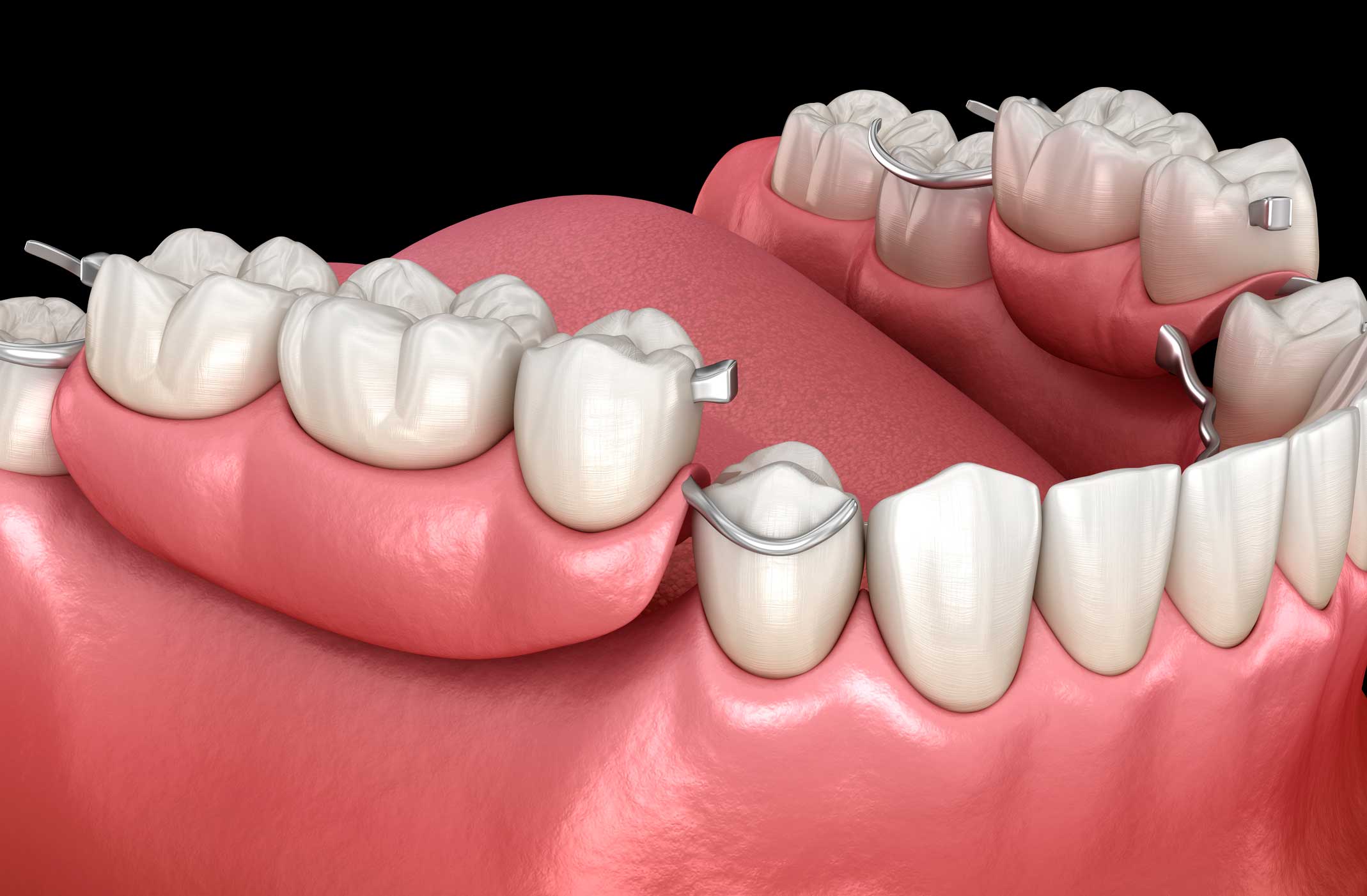 Prótesis dentales en Retiro, Madrid | Odentalia