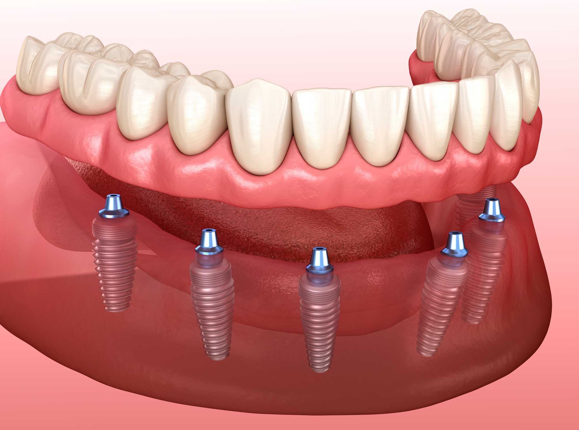Implantes dentales en Retiro, implantes en Retiro, Implantología Oral en Retiro.