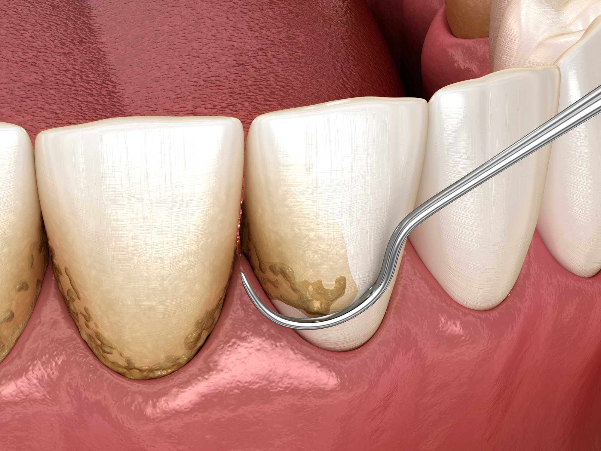 Cirugía Oral en Retiro, cirujano dental en Retiro, Madrid; cirugía bucal en Retiro. Periodoncia en Retiro, tratamientos de periodoncia en Retiro, Madrid; tratamiento para las encías en Retiro, curar las encías.