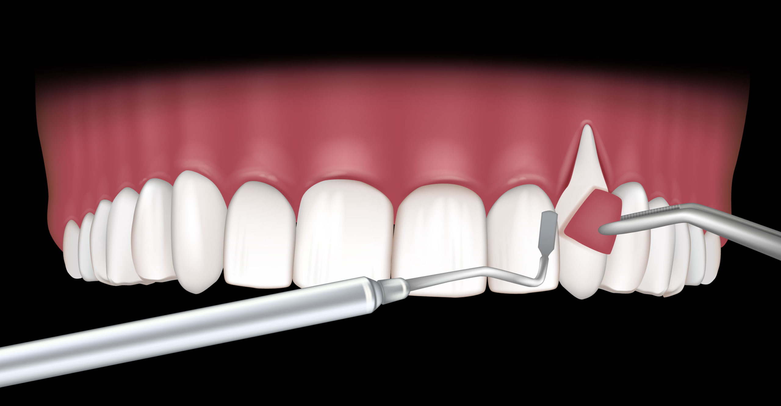 Periodoncia en Retiro, tratamientos de periodoncia en Retiro, Madrid; tratamiento para las encías en Retiro, curar las encías.