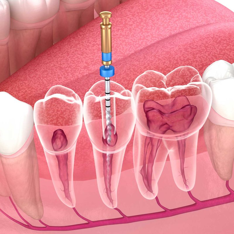 Endodoncia en Retiro, Endodoncista en Retiro, Madrid; tratamiento de conductos en Retiro, Madrid.