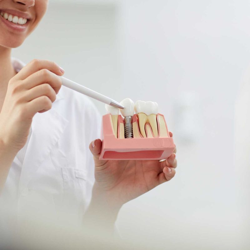 Implantes dentales en Retiro, implantes en Retiro, Implantología Oral en Retiro.